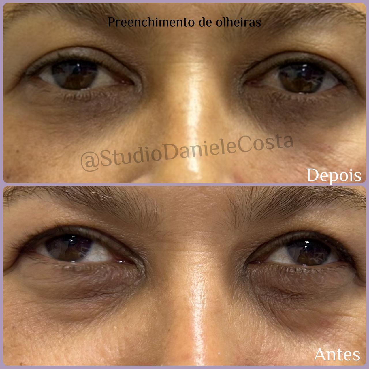 Fotos Camuflagem de estrias / cicatriz / olheiras — foto 2